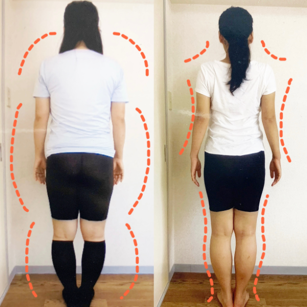 東京都港区南青山の骨盤矯正のビフォーアフター