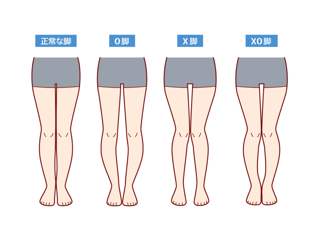 【専門家が解説】O脚とは？原因・セルフチェック・改善方法を完全解説― 放置すると起こる意外なリスクと、専門店で行う本格O脚矯正 ―